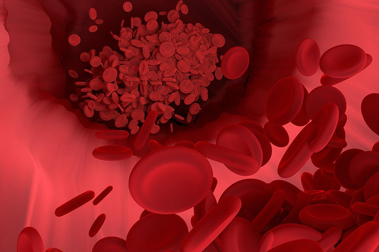 動脈硬化イメージ